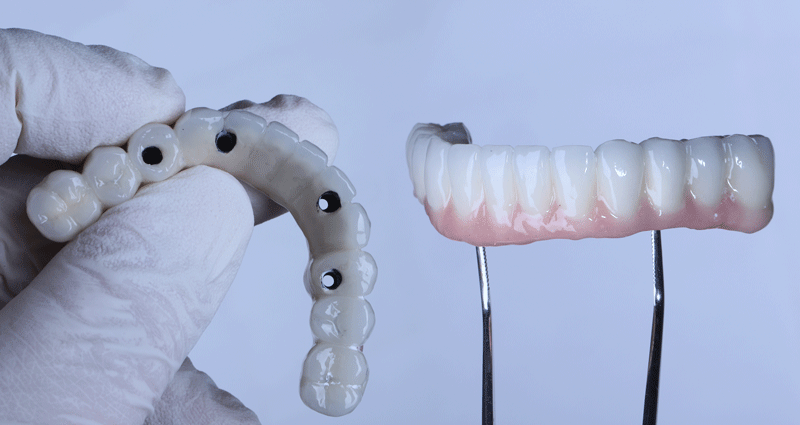 Full arch porcelain dental prosthesis on only 4 implants for completely edentulous jaws in dental jaw surgery and dentistry